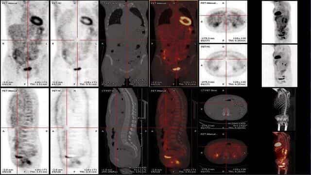 pet-ct-scan-images